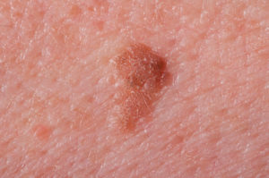 age spots