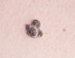 age spots--melanoma signs of skin cancer