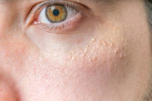 cholesterol deposits vs milia
