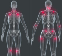 fibromyalgia